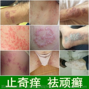 苗药止痒膏快速止痒皮肤湿疹膏过敏皮肤瘙痒抑菌消毒止痒药膏20g