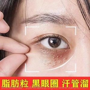 脂肪粒去除神器去脂肪粒眼霜眼部精华去除油脂粒汗管留眼细纹眼霜
